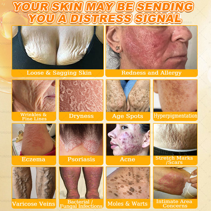 𝑯𝒊𝙢𝒊𝙡𝙠® 𝑩𝐞𝐞 𝑽𝙚𝙣𝙤𝙢 & 𝑻𝙖𝙡𝙡𝙤𝙬 𝑺𝐤𝐢𝐧 𝙍𝐞𝐬𝐭𝐨𝐫𝐚𝐭𝐢𝐨𝐧 𝘾𝐫𝐞𝐚𝐦 (Effective Within 7 Days)𝑩𝐞𝐞 𝑽𝙚𝙣𝙤𝙢 + 𝑻𝙖𝙡𝙡𝙤𝙬 · 7X Deep Hydration, targets wrinkles, sagging, stretch marks, dark spots, purpura, inflammations and more💧