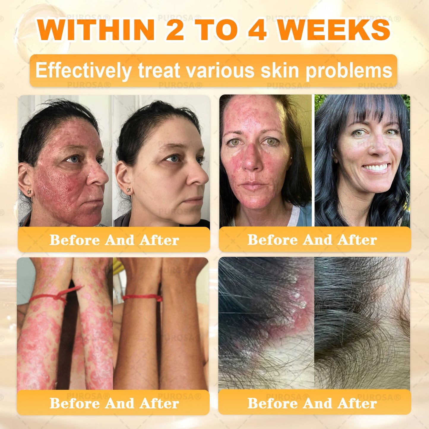 𝑯𝒊𝙢𝒊𝙡𝙠® 𝑩𝐞𝐞 𝑽𝙚𝙣𝙤𝙢 & 𝑻𝙖𝙡𝙡𝙤𝙬 𝑺𝐤𝐢𝐧 𝙍𝐞𝐬𝐭𝐨𝐫𝐚𝐭𝐢𝐨𝐧 𝘾𝐫𝐞𝐚𝐦 (Effective Within 7 Days)𝑩𝐞𝐞 𝑽𝙚𝙣𝙤𝙢 + 𝑻𝙖𝙡𝙡𝙤𝙬 · 7X Deep Hydration, targets wrinkles, sagging, stretch marks, dark spots, purpura, inflammations and more💧